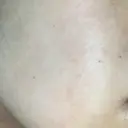 ピーリング（ニキビ・毛穴） 自由が丘クリニック DAY 45 サムネイル用