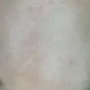 ピーリング（ニキビ・毛穴） 自由が丘クリニック AFTER サムネイル用