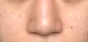 鼻尖形成（切開） / 小鼻縮小（切開） / ヒアルロン酸注入（鼻） 東京ヒルズクリニック 新宿院 AFTER サムネイル用