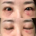 クマ治療 / 下まぶたの脂肪取り TCB東京中央美容外科 中野院 DAY 1 サムネイル用