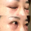 クマ治療 / 下まぶたの脂肪取り TCB東京中央美容外科 中野院 DAY 1 サムネイル用