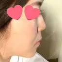 ヒアルロン酸注入（鼻） 青山外苑前クリニック DAY 6 サムネイル用