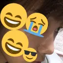 小鼻縮小（切開） / スレッドノーズ / ヒアルロン酸注入（鼻） キップン整形外科 DAY 5 サムネイル用