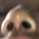 小鼻縮小（切開） / スレッドノーズ / ヒアルロン酸注入（鼻） キップン整形外科 DAY 5 サムネイル用