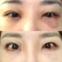 クマ治療 / 下まぶたの脂肪取り TCB東京中央美容外科 中野院 DAY 2 サムネイル用