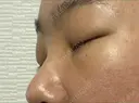 下まぶたの脂肪取り SOグレイスクリニック 御殿山 DAY 3 サムネイル用