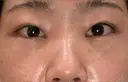 下まぶたの脂肪取り SOグレイスクリニック 御殿山 DAY 4 サムネイル用