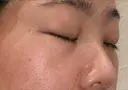 下まぶたの脂肪取り SOグレイスクリニック 御殿山 DAY 4 サムネイル用