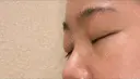 下まぶたの脂肪取り SOグレイスクリニック 御殿山 DAY 4 サムネイル用