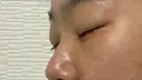 下まぶたの脂肪取り SOグレイスクリニック 御殿山 DAY 5 サムネイル用