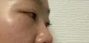下まぶたの脂肪取り SOグレイスクリニック 御殿山 DAY 5 サムネイル用