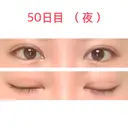 二重切開 水の森美容クリニック 東京新宿院 DAY 50 サムネイル用