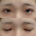 二重埋没 湘南美容クリニック 赤坂見附院 DAY 9 サムネイル用