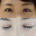 二重切開 / 目頭切開 / 眼瞼下垂（切開） / 目尻切開 湘南美容クリニック 大阪堺東院 AFTER サムネイル用