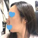 鼻尖形成（切開） / 軟骨移植 / 眉間プロテーゼ / 鼻尖縮小 湘南美容クリニック 柏院 DAY 43 サムネイル用