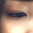 二重埋没 高須クリニック 名古屋院 DAY 55 サムネイル用