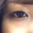 二重埋没 高須クリニック 名古屋院 DAY 55 サムネイル用