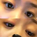 二重埋没 高須クリニック 名古屋院 DAY 92 サムネイル用