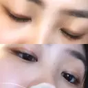 二重埋没 高須クリニック 名古屋院 DAY 245 サムネイル用