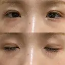 二重埋没 湘南美容クリニック 赤坂見附院 DAY 9 サムネイル用
