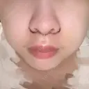 人中短縮 / PRP皮膚再生療法 BIANCA銀座 DAY 3 サムネイル用