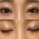 二重切開 / 目頭切開 / 鼻尖形成（切開） / 鼻中隔延長（切開） / 小鼻縮小（切開） / タレ目形成・グラマラスライン（切開） / 鼻尖縮小 / 鼻翼基部形成（貴族手術） グローバルビューティークリニック 大阪院 AFTER サムネイル用