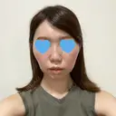 脂肪溶解注射（顔） 赤坂プレミアクリニック DAY 0 サムネイル用