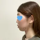 脂肪溶解注射（顔） 赤坂プレミアクリニック DAY 0 サムネイル用