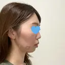 脂肪溶解注射（顔） 赤坂プレミアクリニック DAY 0 サムネイル用