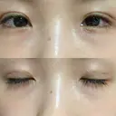 二重埋没 湘南美容クリニック 赤坂見附院 DAY 11 サムネイル用