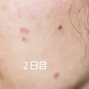 シミ取りレーザー / ルビーレーザー つつじクリニック Akasaka DAY 10 サムネイル用