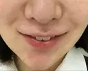 メーラーファット除去 WOM CLINIC GINZA （ワム クリニック ギンザ） DAY 37 サムネイル用