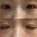 二重埋没 湘南美容クリニック 赤坂見附院 DAY 12 サムネイル用
