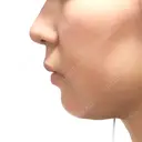 脂肪吸引（顔） / メーラーファット除去 / ボトックス（あご） WOM CLINIC GINZA （ワム クリニック ギンザ） DAY 8 サムネイル用