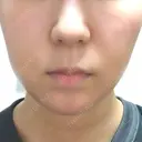 脂肪吸引（顔） / メーラーファット除去 / ボトックス（あご） WOM CLINIC GINZA （ワム クリニック ギンザ） DAY 8 サムネイル用