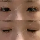 二重埋没 湘南美容クリニック 赤坂見附院 DAY 13 サムネイル用