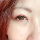 下まぶたの脂肪取り 湘南美容クリニック 千葉センシティ院 DAY 10 サムネイル用