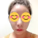 骨切り（あご） / 骨削り（頬） / ガミースマイル手術 / ルフォー+ssro（両あご) ウォンジン（Wonjin）整形外科 DAY 227 サムネイル用