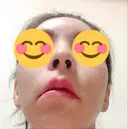 骨切り（あご） / 骨削り（頬） / ガミースマイル手術 / ルフォー+ssro（両あご) ウォンジン（Wonjin）整形外科 DAY 227 サムネイル用