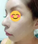 骨切り（あご） / 骨削り（頬） / ガミースマイル手術 / ルフォー+ssro（両あご) ウォンジン（Wonjin）整形外科 DAY 227 サムネイル用