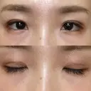 二重埋没 湘南美容クリニック 赤坂見附院 DAY 14 サムネイル用