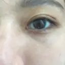 下まぶたたるみ取り セオリークリニック DAY 32 サムネイル用