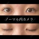 二重埋没 東京形成美容外科 船橋院 DAY 113 サムネイル用