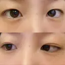 二重埋没 高須クリニック 名古屋院 AFTER サムネイル用