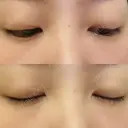 二重埋没 高須クリニック 名古屋院 DAY 366 サムネイル用