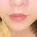 人中短縮 / PRP皮膚再生療法 BIANCA銀座 DAY 9 サムネイル用
