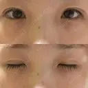 二重埋没 湘南美容クリニック 赤坂見附院 DAY 15 サムネイル用