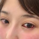 クマ治療 TCB東京中央美容外科 中野院 DAY 3 サムネイル用