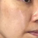 シミ取りレーザー / YAGレーザー 仁愛クリニック DAY 78 サムネイル用