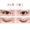 二重切開 水の森美容クリニック 東京新宿院 DAY 61 サムネイル用